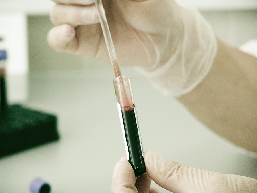 blood sample for zinc copper test