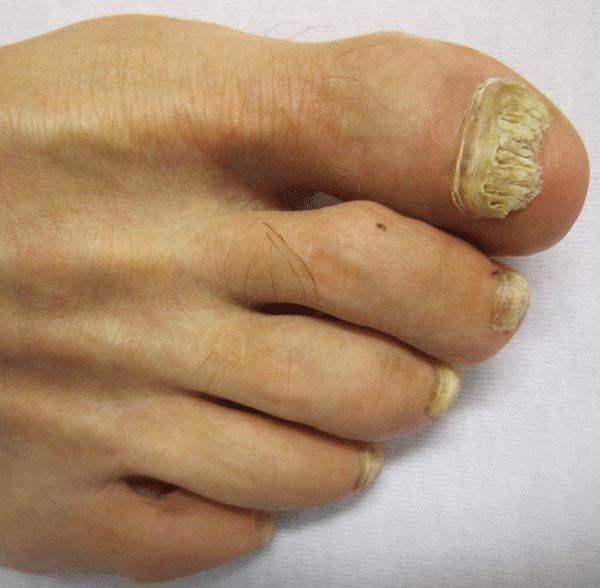 Toenail fungus remedies